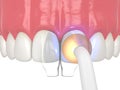 3d render of diastema closure using bonding procedure