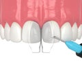 3d render of applying composite resin to close diastema Royalty Free Stock Photo