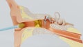 3d render ear cleansing earwax ear stick. 3d illustration Royalty Free Stock Photo