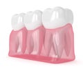 3d render of gum with cracked tooth root Royalty Free Stock Photo