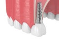 3d render of gum cross-secton with implant placement