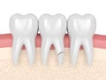 3d render of gums with cracked tooth root