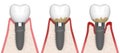 3d render of human gums cross-section with peri implantitis disease Royalty Free Stock Photo