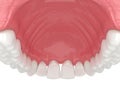 3d render of human upper jaw with black triangles