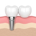 3d render of implant with dental cantilever bridge