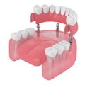 3d render of implant partial denture