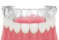 3d render of invisalign removable retainer with lower jaw Royalty Free Stock Photo