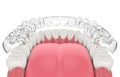 3d render of invisalign removable retainer with lower jaw Royalty Free Stock Photo