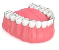 3d render of invisalign removable retainer with lower jaw Royalty Free Stock Photo