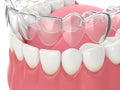 3d render of invisalign removable retainer with lower jaw