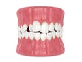 3d render of jaw with abnormal toothing position isolated over white background