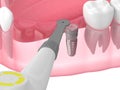 3d render of jaw with buried healing cap and smart implant detector