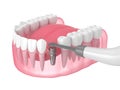 3d render of jaw with buried healing cap and smart implant detector