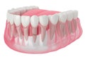 3d render of jaw with cracked tooth root Royalty Free Stock Photo