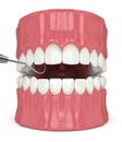 3d render of jaw with dental explorer over white