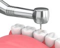 3d render of jaw with dental handpiece and drill Royalty Free Stock Photo