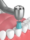 3d render of jaw with dental handpiece and polishing prophy cup Royalty Free Stock Photo