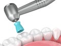 3d render of jaw with dental handpiece and polishing prophy cup Royalty Free Stock Photo