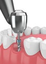 3d render of jaw with dental implant drill Royalty Free Stock Photo