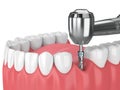 3d render of jaw with dental implant drill Royalty Free Stock Photo