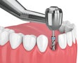 3d render of jaw with dental implant drill Royalty Free Stock Photo