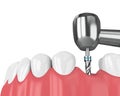 3d render of jaw with dental implant drill Royalty Free Stock Photo