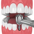 3d render of jaw with dental implant drill Royalty Free Stock Photo