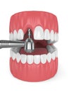 3d render of jaw with dental implant drill Royalty Free Stock Photo