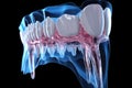 3d render of jaw with denture in x-ray image, 3d render of jaw x-ray with aching tooth, AI Generated Royalty Free Stock Photo