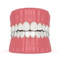 3d render of jaw with invisalign removable retainer Royalty Free Stock Photo