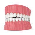 3d render of jaw with invisalign removable retainer Royalty Free Stock Photo
