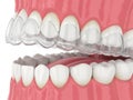 3d render of jaw with invisalign removable retainer Royalty Free Stock Photo