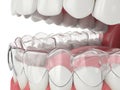 3d render of jaw with invisalign removable retainer Royalty Free Stock Photo