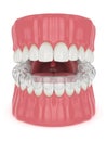 3d render of jaw with invisalign removable retainer Royalty Free Stock Photo