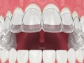 3d render of jaw with invisalign removable retainer