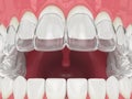 3d render of jaw with invisalign removable retainer Royalty Free Stock Photo