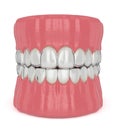 3d render of jaw with invisalign removable retainers