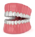 3d render of jaw with invisalign removable retainers