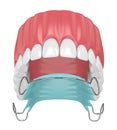 3d render of jaw with orthodontic removable retainer