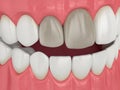 3d render of jaw and teeth with dead pulp Royalty Free Stock Photo