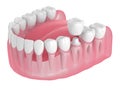 3d render of jaw with teeth and dental crown restoration