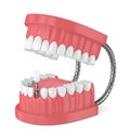 3d render of jaw with teeth and dental incisor implant Royalty Free Stock Photo
