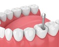 3d render of jaw with teeth and dental metal post