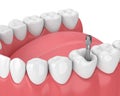 3d render of jaw with teeth and dental metal post