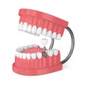 3d render of jaw with teeth and dental molar implant