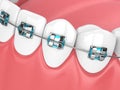 3d render of jaw with teeth and orthodontic braces