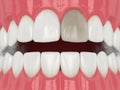 3d render of jaw and tooth with dead pulp Royalty Free Stock Photo