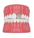 3d render of jaw and tooth with dead pulp Royalty Free Stock Photo