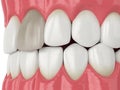 3d render of jaw and tooth with dead pulp Royalty Free Stock Photo
