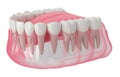 3d render of jaw with cracked tooth
